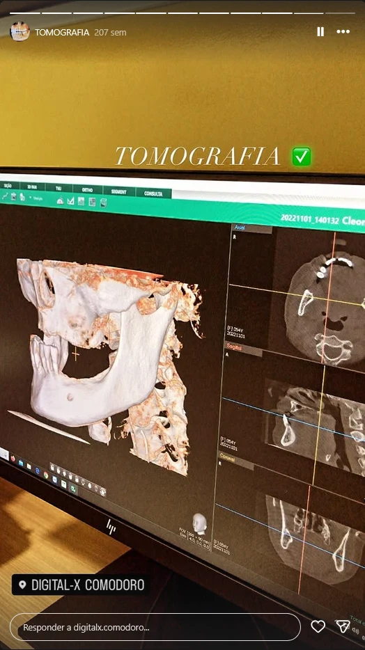 Reconstrução de maxila e mandíbula em exame de tomografia