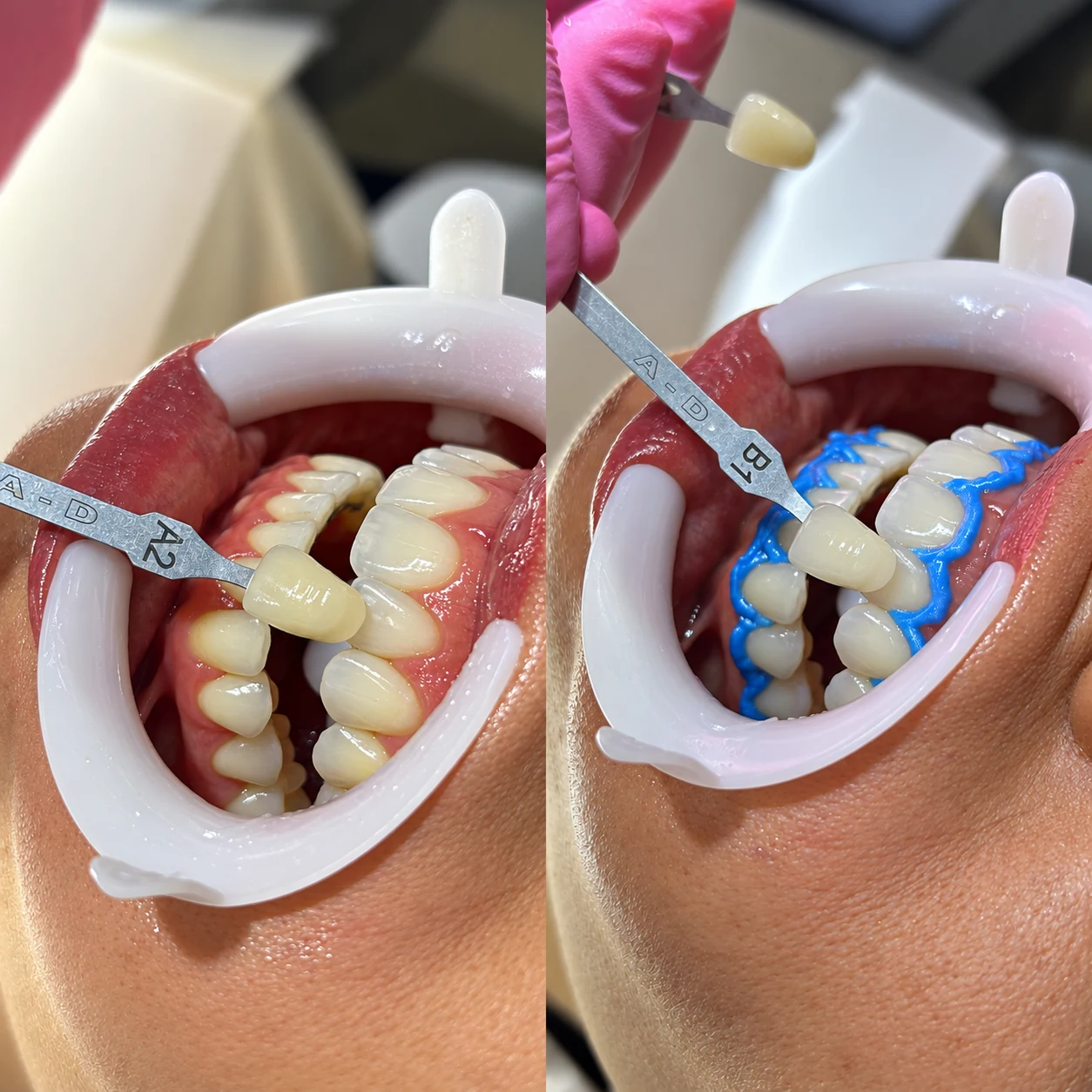 Montagem de registros odontológicos com escala de cor